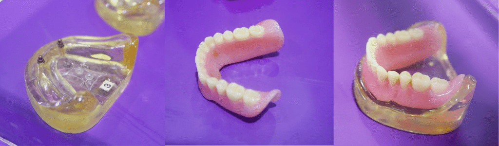 Permanent Denture stages