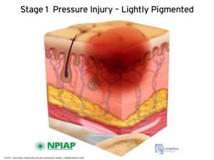 Stage 1 Pressure Injury Lightly Pigmented